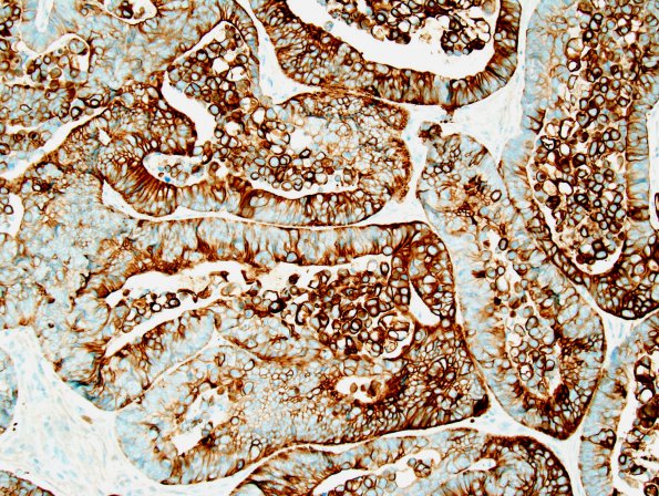 1B2 Metastatic colon ca (Case 1) CK20 1.jpg