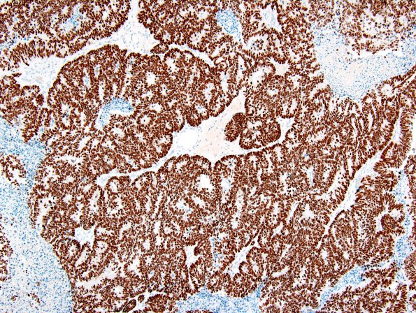 1C Metastatic colon ca (Case 1) CDX2 1.jpg