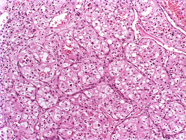 21A Metastases Renal (Case 21) a