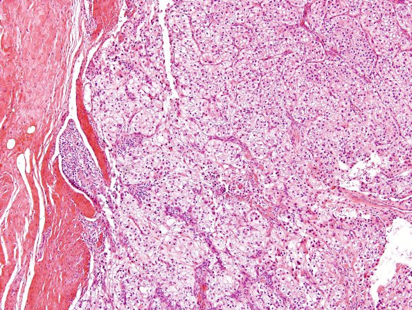 22A1 Metastases Renal (Case 21) 1