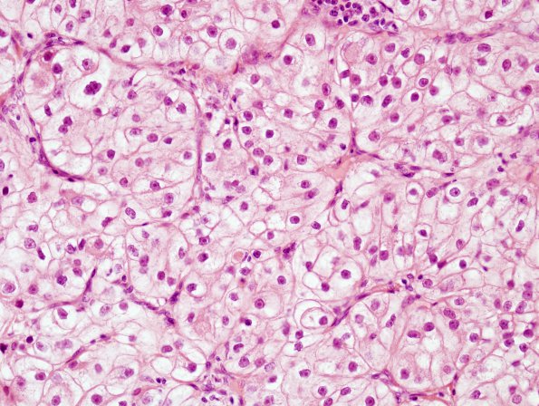 22A2 Metastases Renal (Case 22) 2