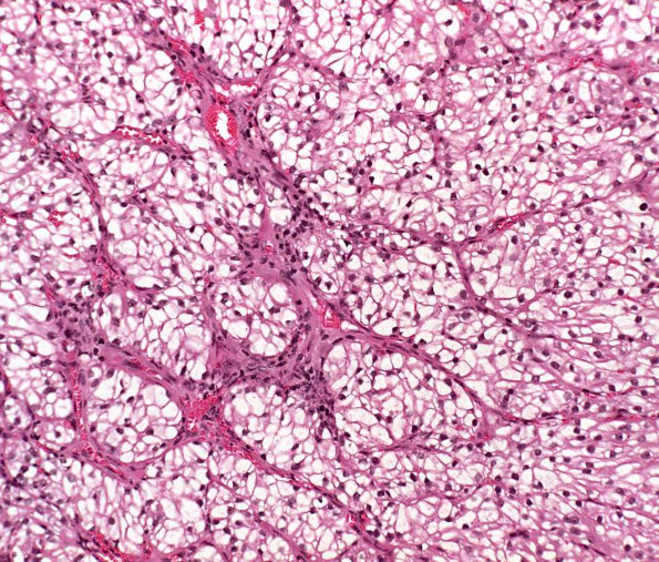 23A Metastases Renal (Case 23)