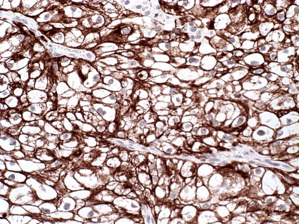 23B Metastases Renal (Case 23) CK