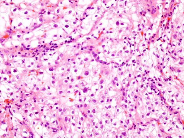 24 Metastases Renal CA (Case 24) 1