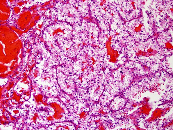 25A1Metastases, renal (Case 25) H&E 3.jpg