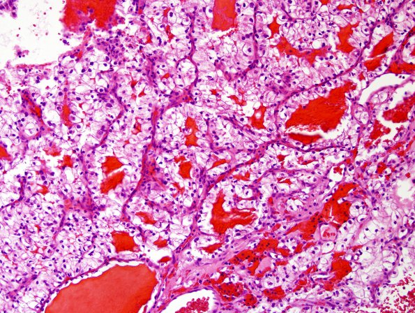 25A2 Metastases, renal (Case 25) H&E 2.jpg