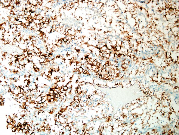 25B2 Metastases, renal (Case 25) RCC - Copy.jpg