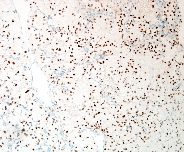 25B1 Metastases, renal (Case 25) PAX-8 2.jpg