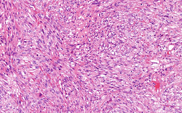 26A1 Metastases, renal (Case 26) H&E 1