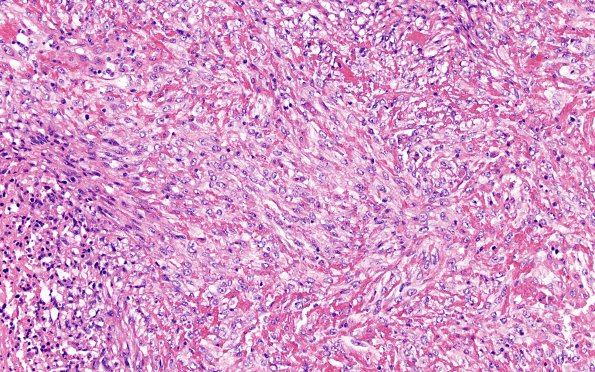 26A2 Metastases, renal (Case 26) H&E 4