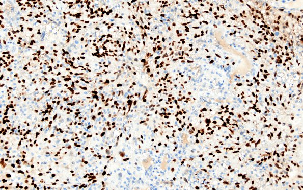 26B Metastases, renal (Case 26) PAX-8