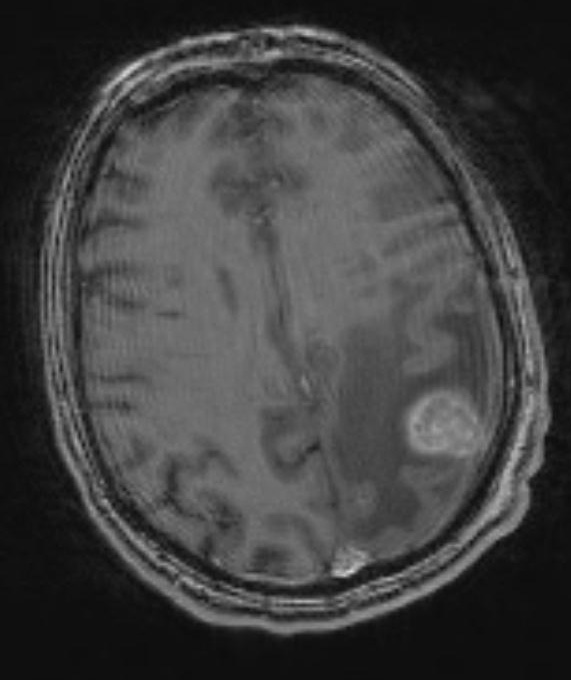 27A Metastasis, kidney (Case 27) T1 W 5