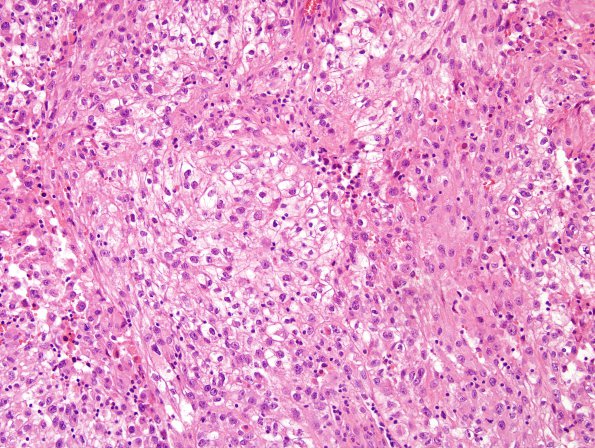 27B Metastasis, kidney (Case 27) H&E 1