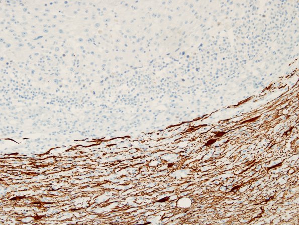 27C Metastasis, kidney (Case 27) GFAP 2