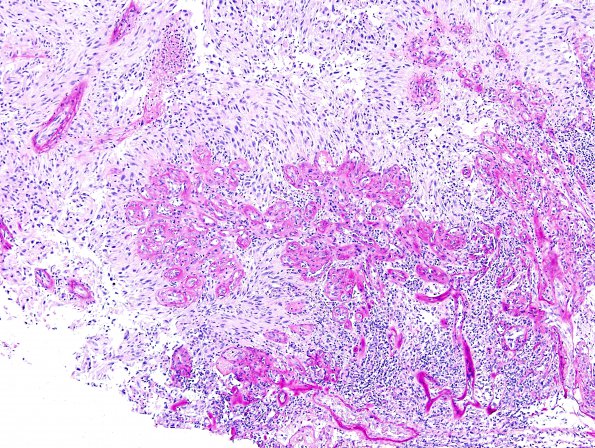 27D3 Metastasis, kidney (Case 27) PAS wD