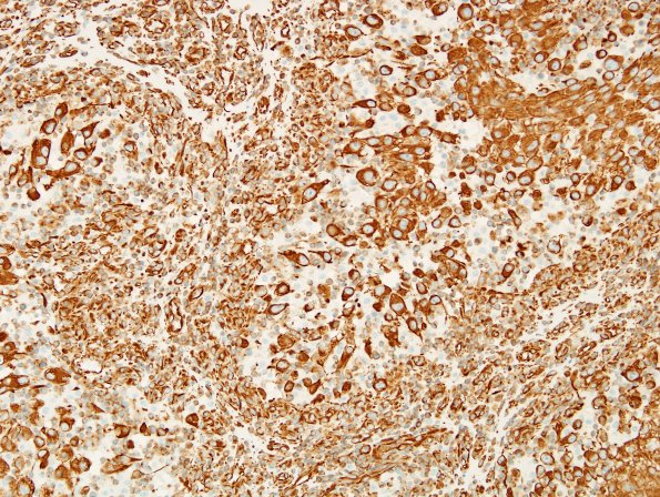 27E Metastasis, kidney (Case 27) VIM