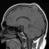 29A1 Metastasis, renal  (Case 29) T1 1