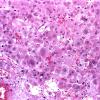 2A Metastases Liver origin (Case 2)