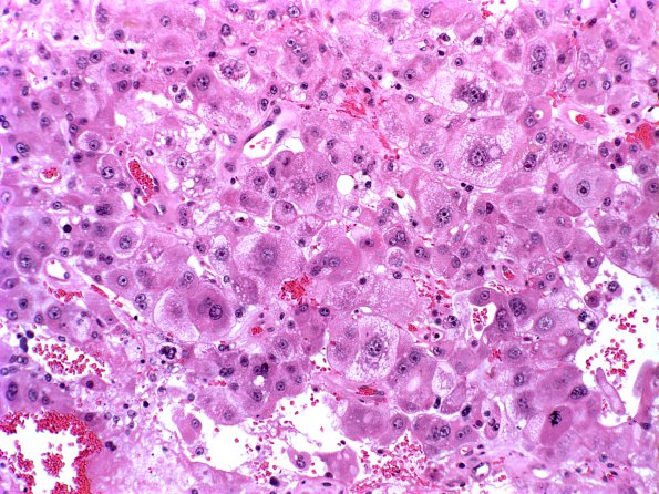 2A Metastases Liver origin (Case 2)