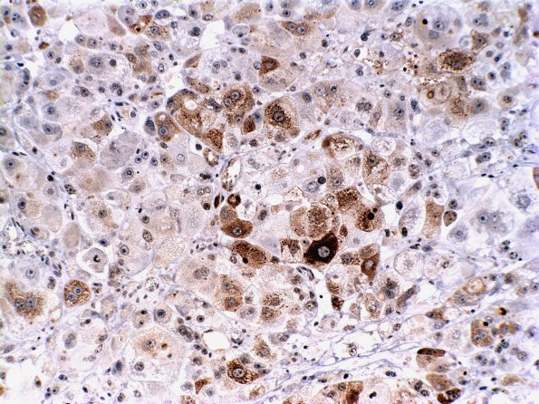 2B Metastases Liver origin (Case 2) AFP
