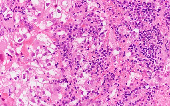 30A1 Metastasis, renal (Case 30) H&E 2