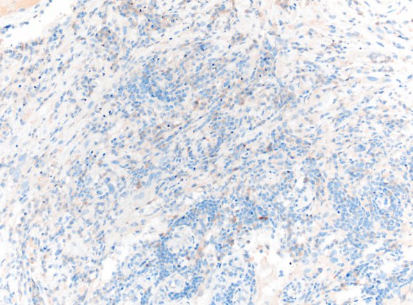 30B1 Metastasis, renal (Case 30) Inhibin