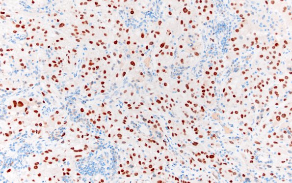 30B2 Metastasis, renal (Case 30) PAX-8