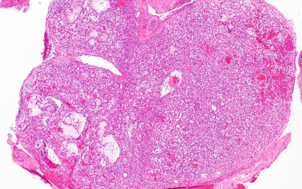 31A1 Metastasis, renal (Case 31) H&E 5