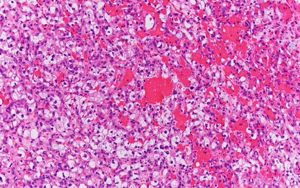 31A2 Metastasis, renal (Case 31) H&E 1