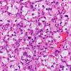 31B3 Metastasis, renal (Case 31) H&E 3