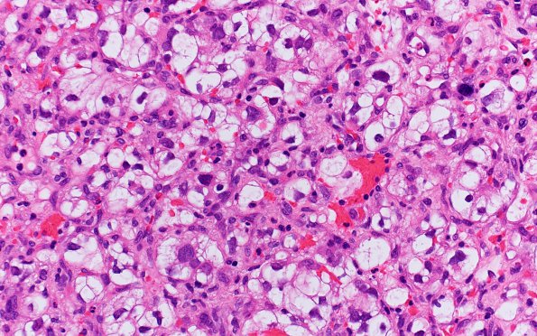 31B3 Metastasis, renal (Case 31) H&E 3