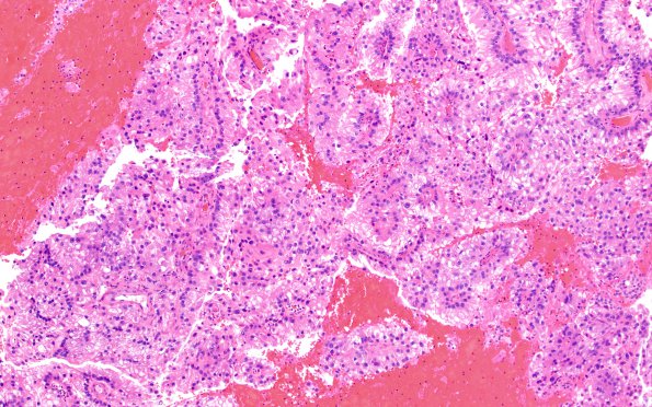 32A1 Metastasis, renal origin (Case 32) H&E 6