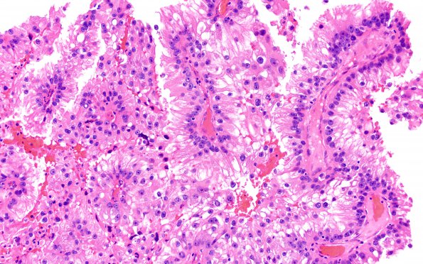 32A2 Metastasis, renal origin (Case 32) H&E 7