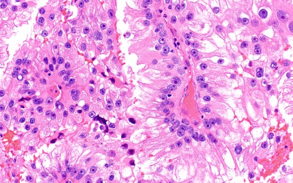 32A3 Metastasis, renal origin (Case 32) H&E 8