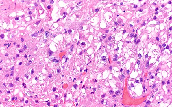 32A4 Metastasis, renal origin (Case 32) H&E 4