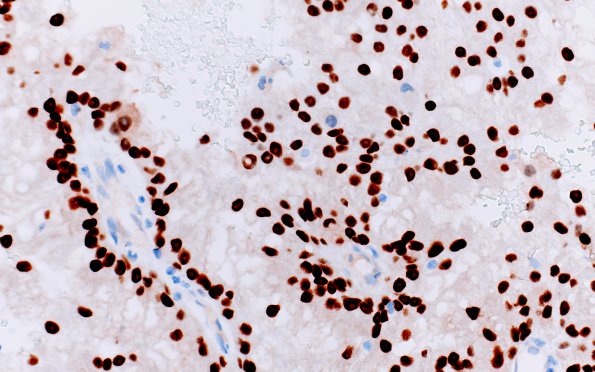 32B Metastasis, renal origin (Case 32) PAX-8 2