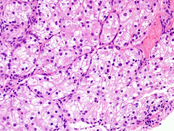 33A Metastasis, renal (Case 33) H&E