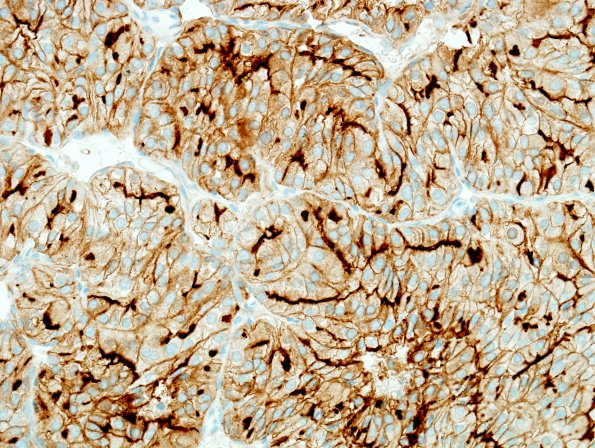 33B Metastasis, renal (Case 33) CD10 2