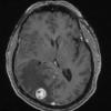 34A Metastasis, renal (Case 34) T1 W 2