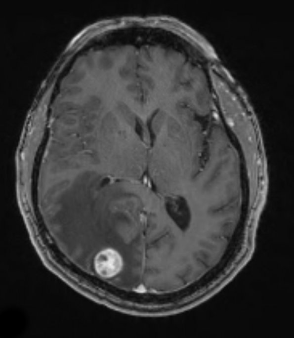 34A Metastasis, renal (Case 34) T1 W 2