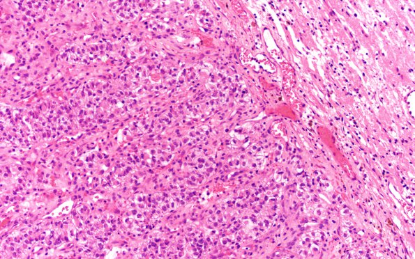 34B Metastasis, renal (Case 34) H&E 20X