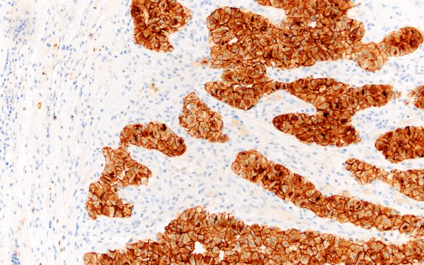 34C Metastasis, renal (Case 34) CD10 20X