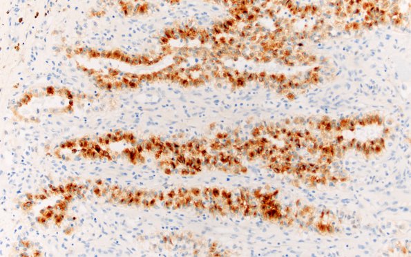 34D Metastasis, renal (Case 34) RCC 20X