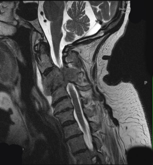 35A Metastasis, renal (Case 35) T2 1