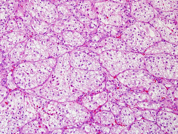 35B1 Metastasis, renal (Case 35) H&E 3.jpg