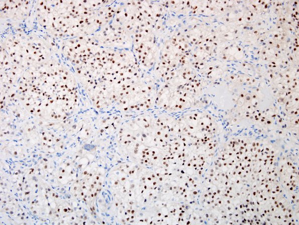 35C1 Metastasis, renal (Case 35) PAX-8.jpg