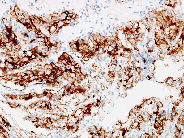 35C2 Metastasis, renal (Case 35) CD10 1.jpg