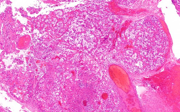 36A Metastasis, renal cell (Case 36) H&E 4