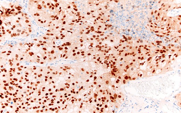 36C Metastasis, renal cell (Case 36) PAX-8 1