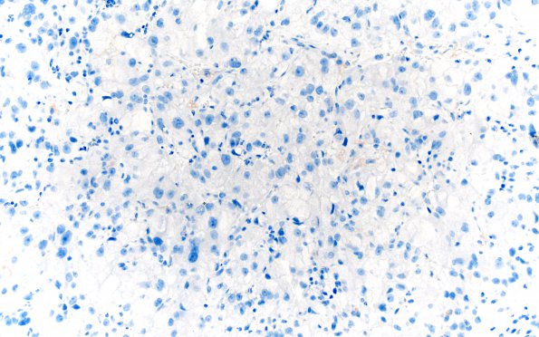 37E Metastasis, renal cell (Case 37) Inhibin 20X